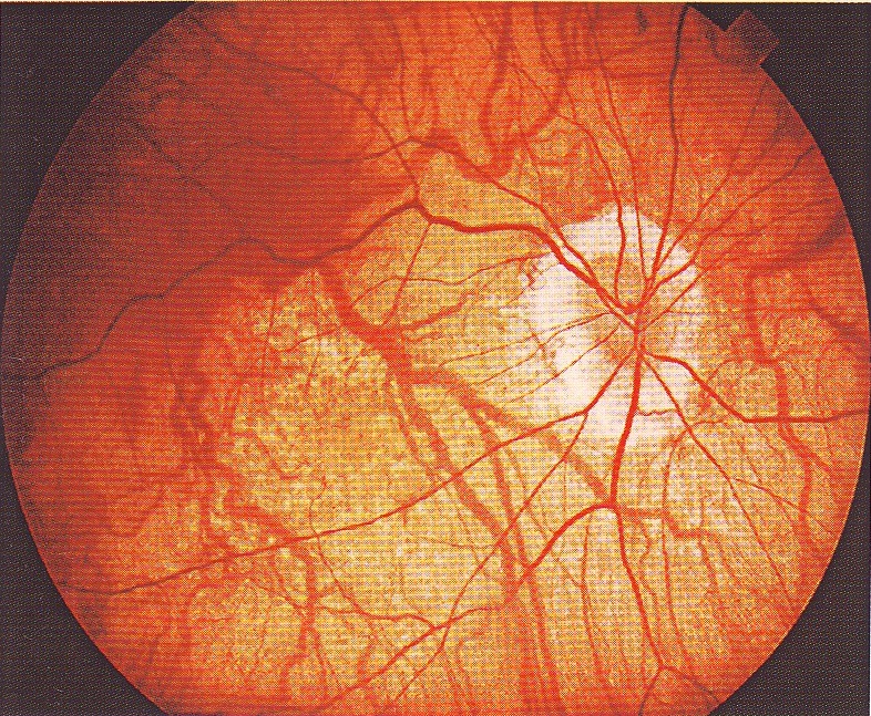 Макулопатия глаза. Глазное дно миопическая стафилома. Миопическая стафилома сетчатки.