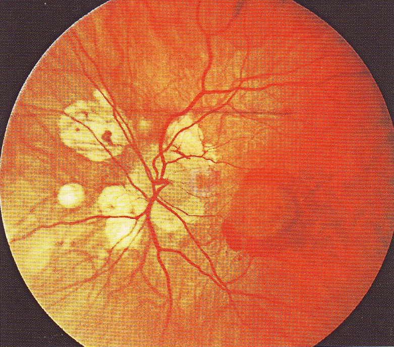 Макулопатия глаза. Миопическая стафилома сетчатки. Миопический конус и стафилома. Периферическая хориоретинальная дистрофия (ПХРД).